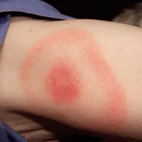 Lyme disease rash