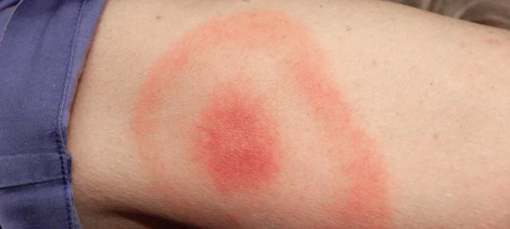 Lyme disease rash