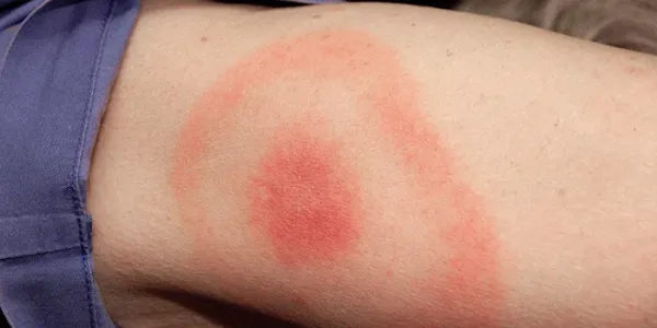 Lyme disease rash